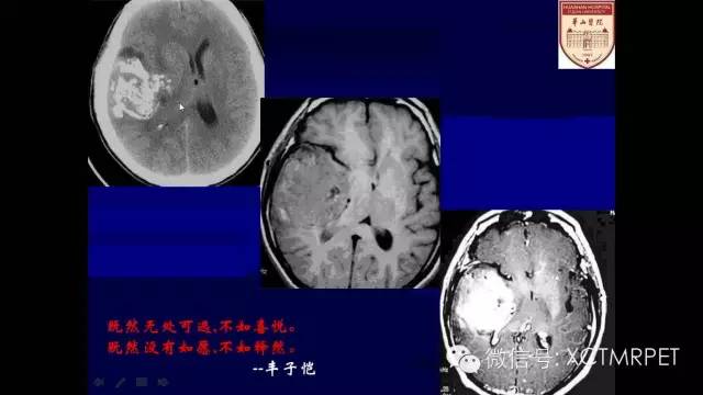 脑肿瘤的MRI