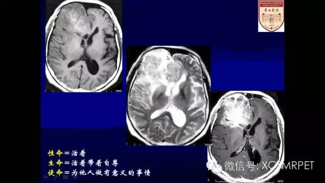 脑肿瘤的MRI