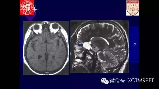脑肿瘤的MRI