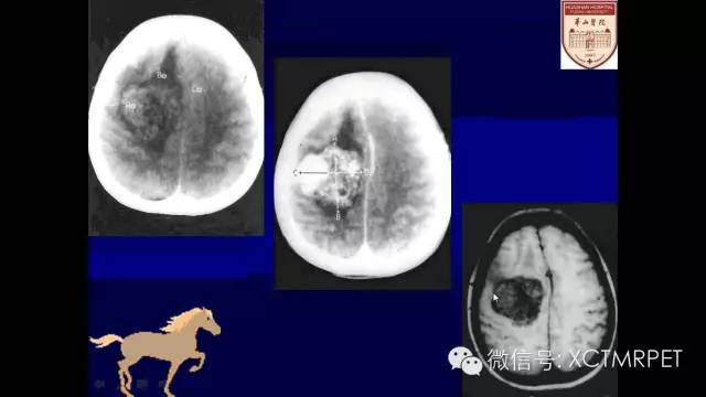 脑肿瘤的MRI