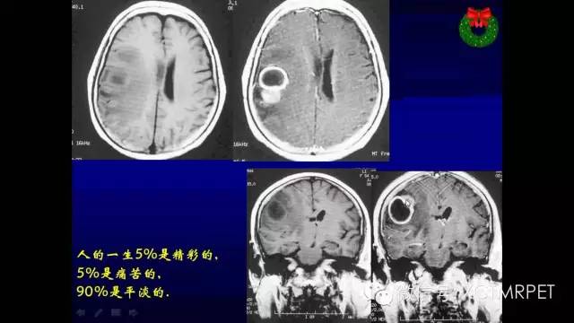脑肿瘤的MRI