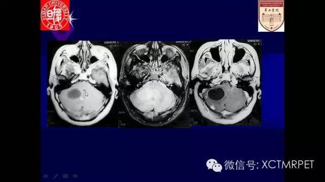 脑肿瘤的MRI