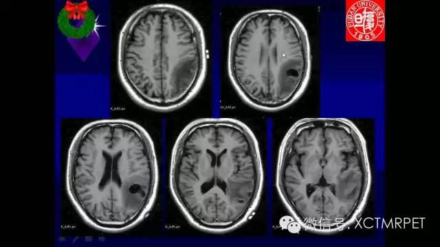 脑肿瘤的MRI