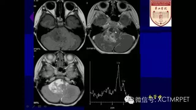 脑肿瘤的MRI