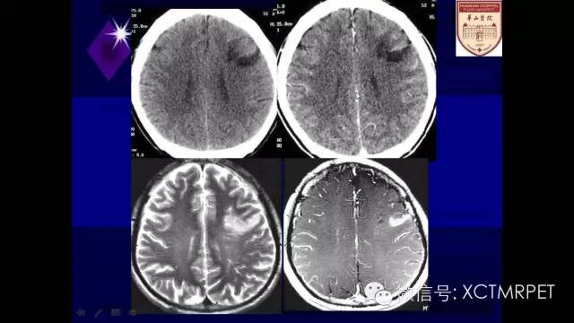 脑肿瘤的MRI