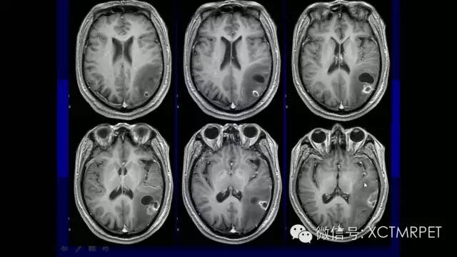 脑肿瘤的MRI