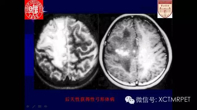 脑肿瘤的MRI