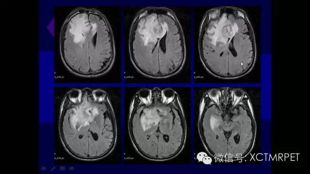 脑肿瘤的MRI