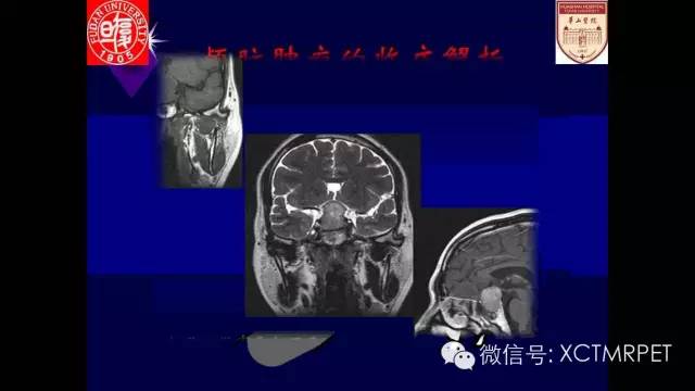 脑肿瘤的MRI