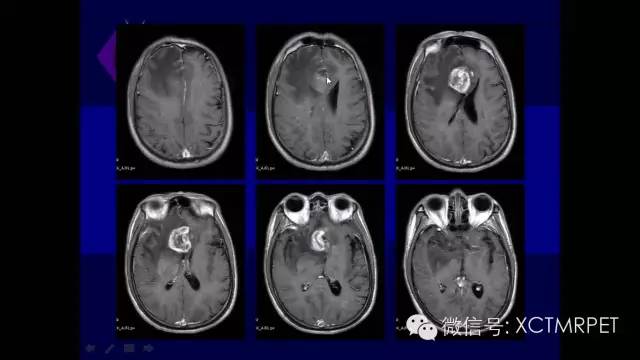 脑肿瘤的MRI