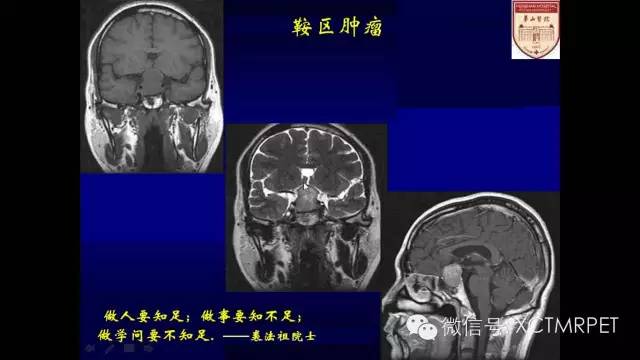 脑肿瘤的MRI