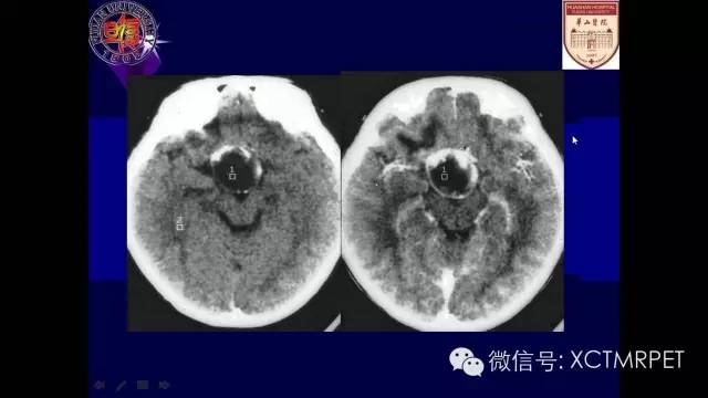 脑肿瘤的MRI