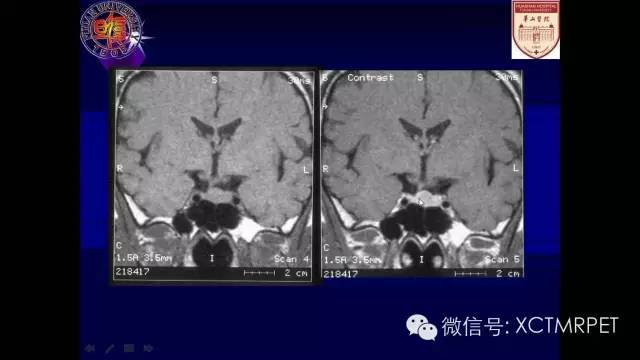 脑肿瘤的MRI