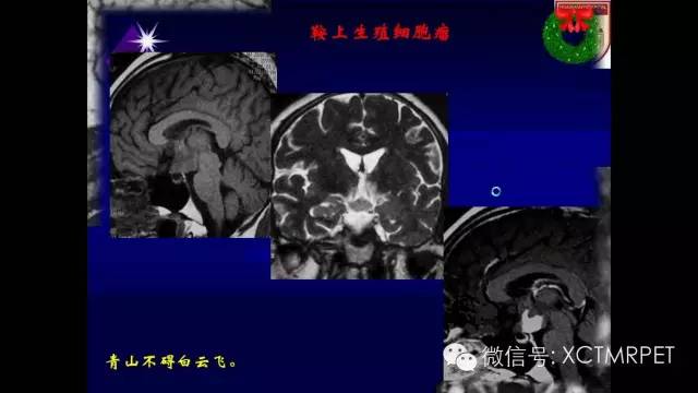 脑肿瘤的MRI