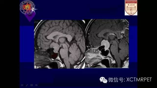 脑肿瘤的MRI