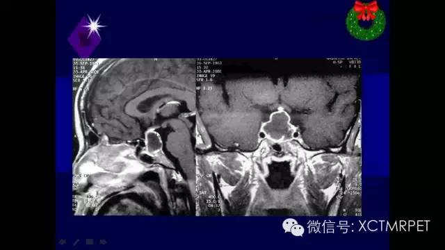 脑肿瘤的MRI