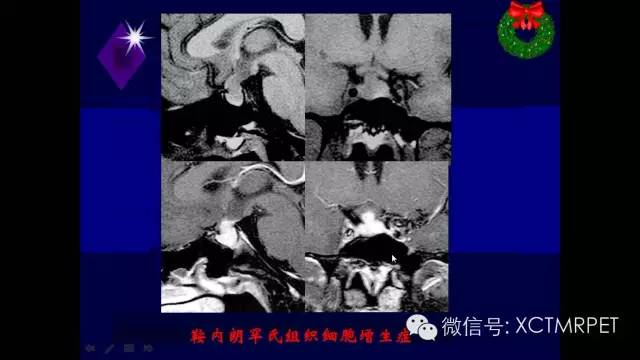 脑肿瘤的MRI