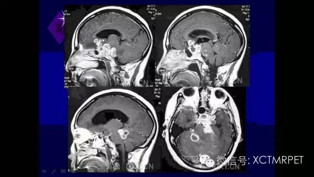 脑肿瘤的MRI