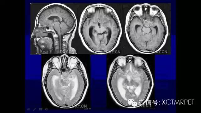 脑肿瘤的MRI