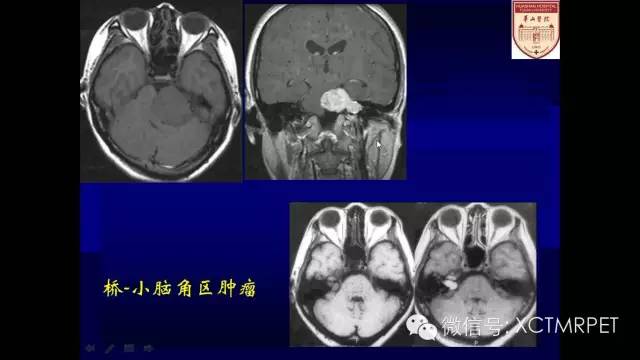 脑肿瘤的MRI
