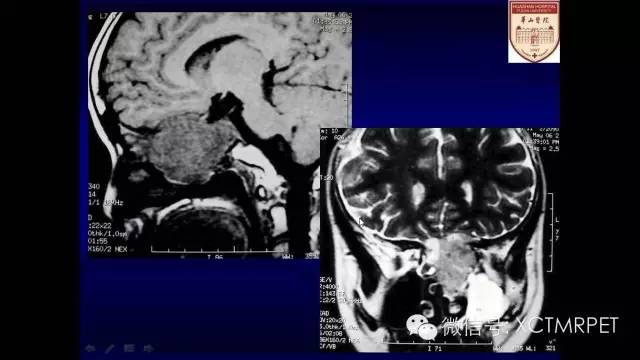 脑肿瘤的MRI