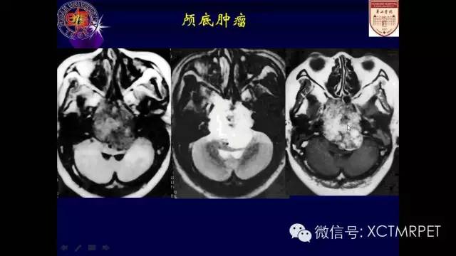 脑肿瘤的MRI