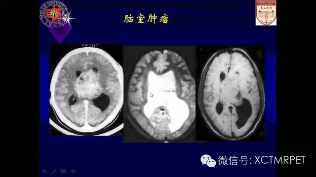 脑肿瘤的MRI