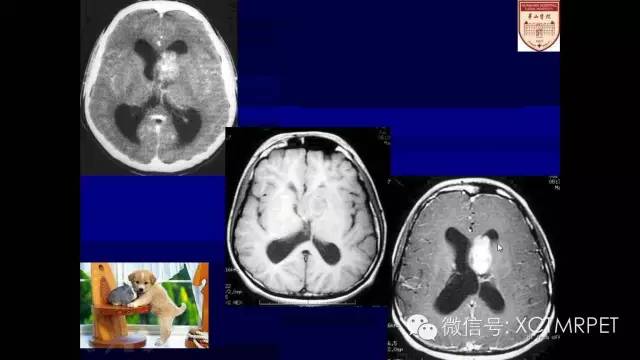 脑肿瘤的MRI