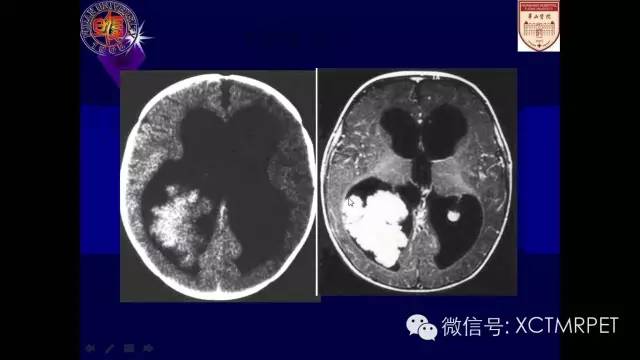 脑肿瘤的MRI