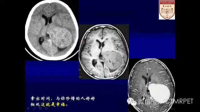 脑肿瘤的MRI