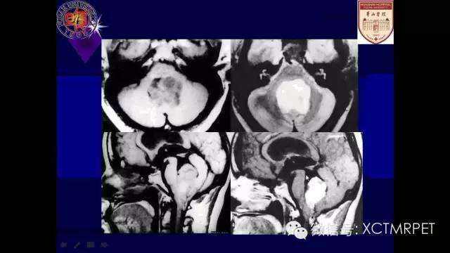 脑肿瘤的MRI