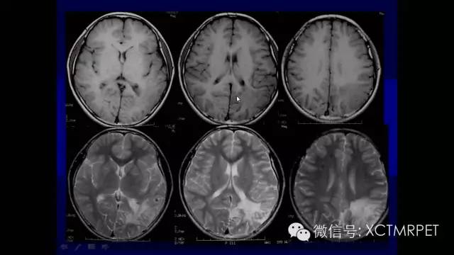脑肿瘤的MRI