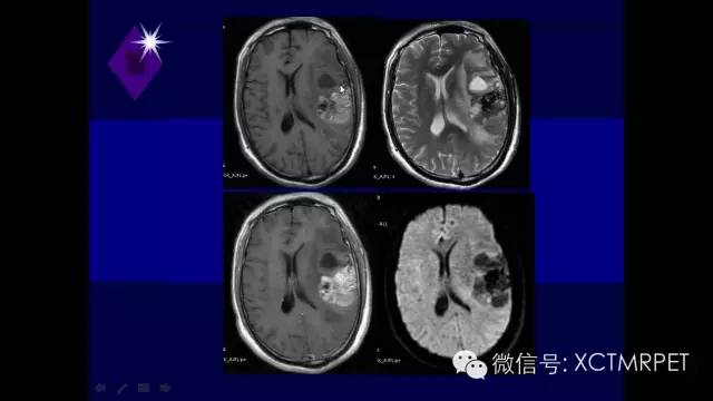 脑肿瘤的MRI