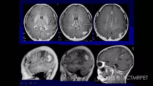 脑肿瘤的MRI