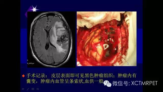 脑肿瘤的MRI