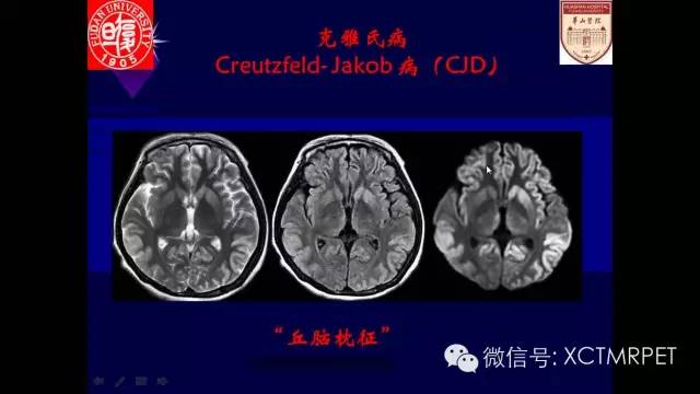 脑肿瘤的MRI