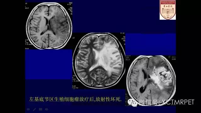 脑肿瘤的MRI