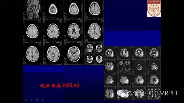 脑肿瘤的MRI