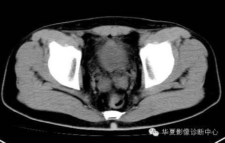 【病例】氯胺酮（Ｋ粉）相关性膀胱炎1例CT及MR影像表现