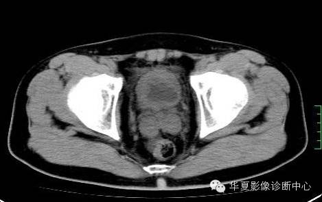 【病例】氯胺酮(K粉)相关性膀胱炎1例CT及MR影像表现 【病例】氯胺酮(K粉)相关性膀胱炎1例CT及MR影像表现