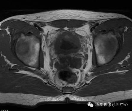 【病例】氯胺酮(K粉)相关性膀胱炎1例CT及MR影像表现 【病例】氯胺酮(K粉)相关性膀胱炎1例CT及MR影像表现