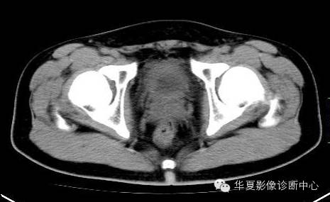 【病例】氯胺酮(K粉)相关性膀胱炎1例CT及MR影像表现 【病例】氯胺酮(K粉)相关性膀胱炎1例CT及MR影像表现
