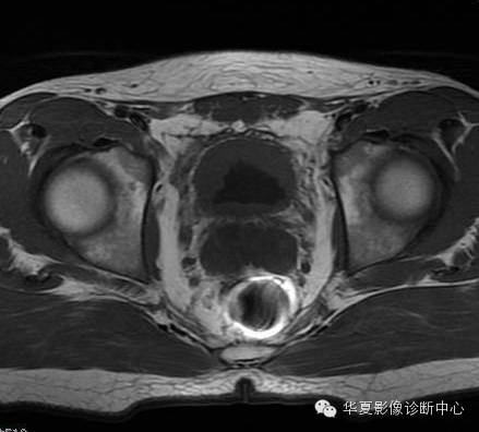 【病例】氯胺酮(K粉)相关性膀胱炎1例CT及MR影像表现 【病例】氯胺酮(K粉)相关性膀胱炎1例CT及MR影像表现