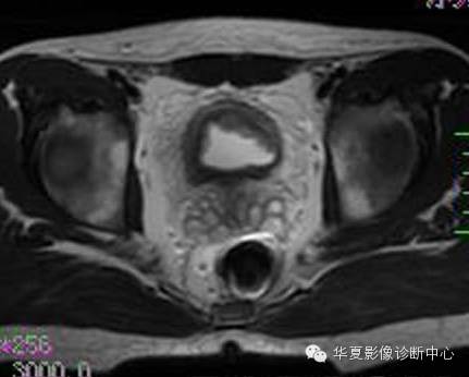【病例】氯胺酮(K粉)相关性膀胱炎1例CT及MR影像表现 【病例】氯胺酮(K粉)相关性膀胱炎1例CT及MR影像表现