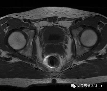 【病例】氯胺酮(K粉)相关性膀胱炎1例CT及MR影像表现 【病例】氯胺酮(K粉)相关性膀胱炎1例CT及MR影像表现