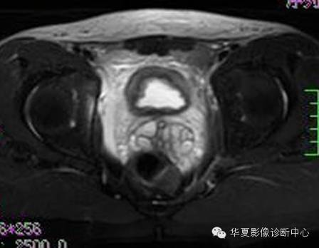 【病例】氯胺酮(K粉)相关性膀胱炎1例CT及MR影像表现 【病例】氯胺酮(K粉)相关性膀胱炎1例CT及MR影像表现