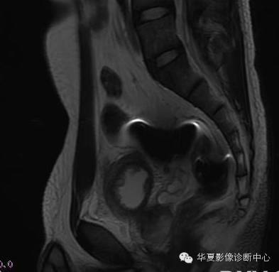 【病例】氯胺酮(K粉)相关性膀胱炎1例CT及MR影像表现 【病例】氯胺酮(K粉)相关性膀胱炎1例CT及MR影像表现