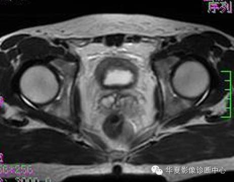 【病例】氯胺酮(K粉)相关性膀胱炎1例CT及MR影像表现 【病例】氯胺酮(K粉)相关性膀胱炎1例CT及MR影像表现