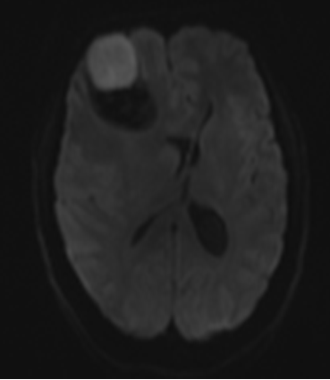 【病例】囊性脑膜瘤1例MR影像表现 【病例】囊性脑膜瘤1例MR影像表现