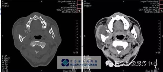 【病例】造釉细胞瘤1例CT影像表现